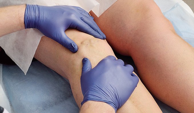 Mes de lucha contra las várices: Diagnóstico y tratamiento oportunos para evitar complicaciones